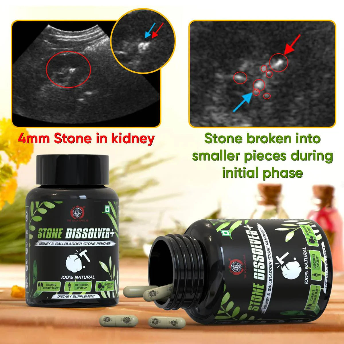 Kidney & Stones - Consumer Safety Labs