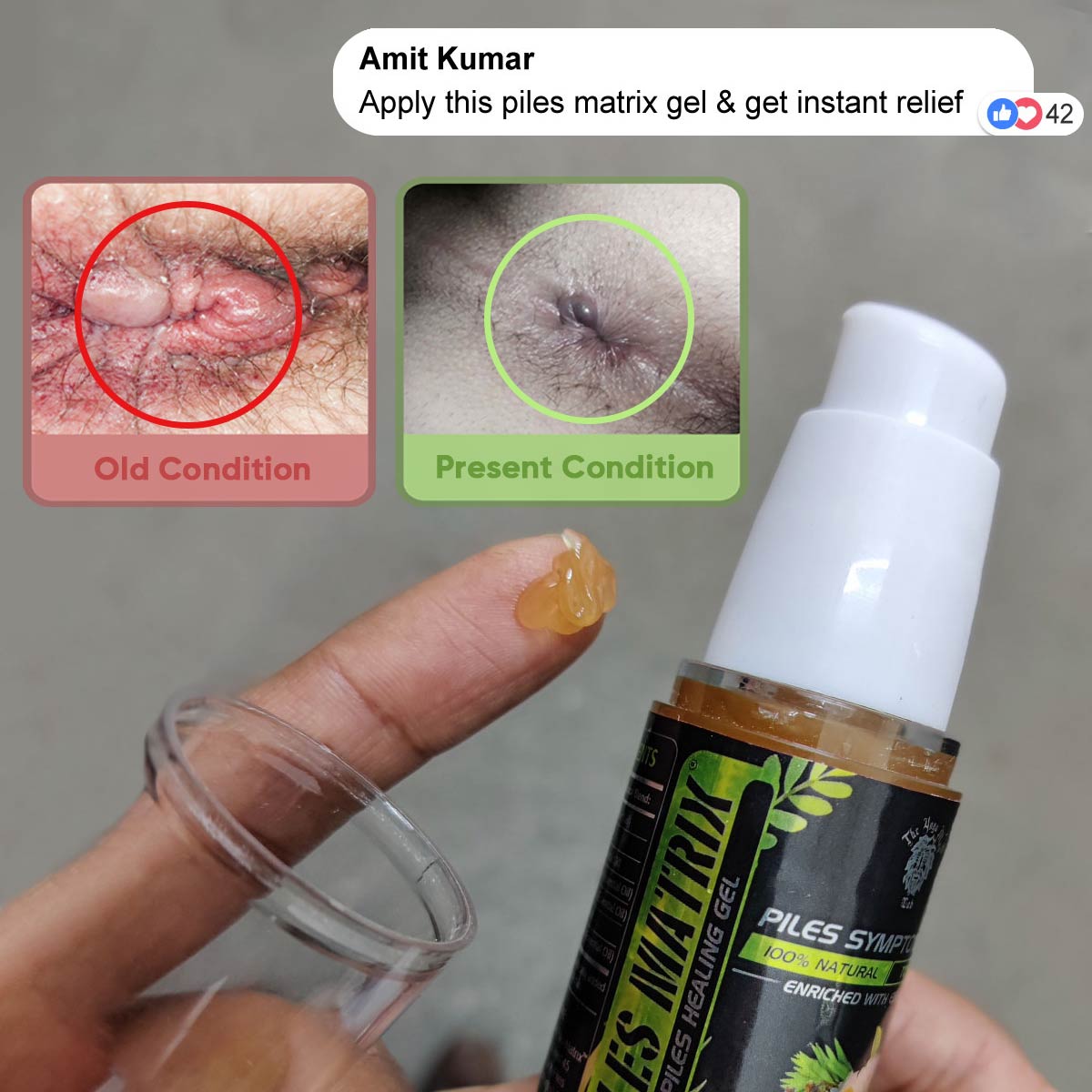 PILES MATRIX - Piles Treatment Ayurvedic Capsules & Lepam Ointment | With Free Diet & Doctor | Treats Internal Grade1-4 & External Hemorrhoids | 100% Natural