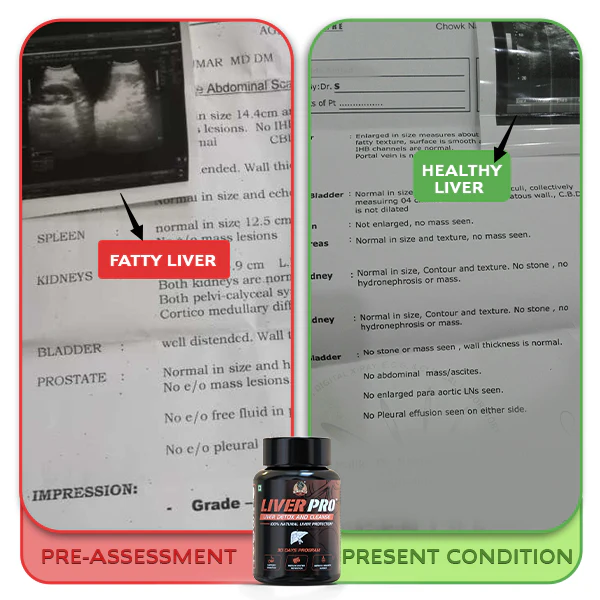 YogaManLab® Liver Pro - Fatty Liver Ayurvedic Supplement | Helps Restore Liver Health & Remove Toxins | 100% Natural & Ayurvedic | 28 Days Program